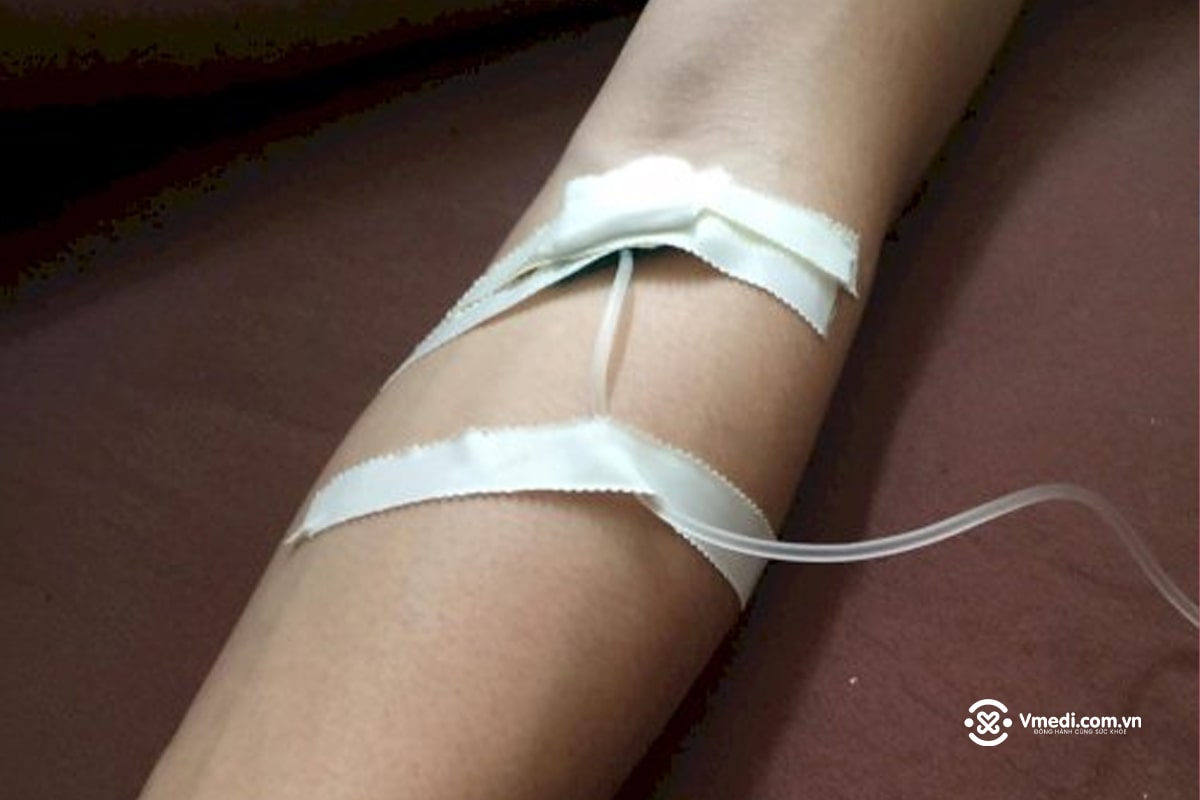 anh-ghim-kim-luon-truyen-nuoc-bien-tai-benh-vien