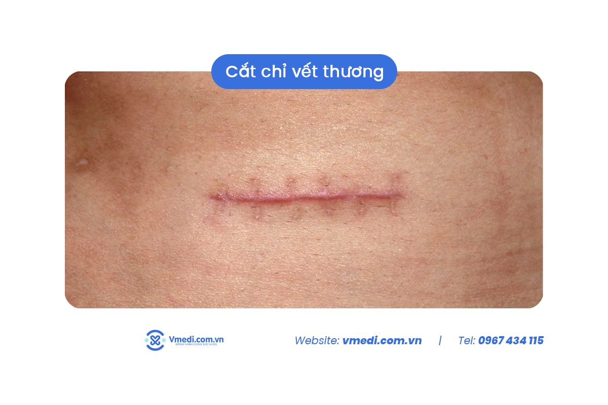 cach-cat-chi-vet-thuong