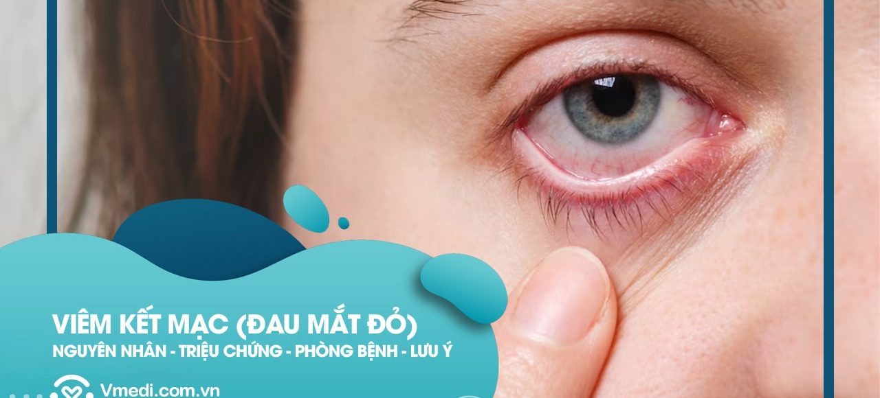 benh-viem-ket-mac-dau-mat-do